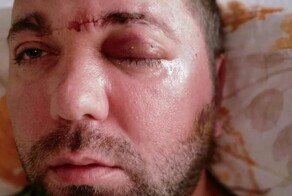 В Турции стоматолог вкрутил зубной имплант в полость мозга пациента и сбежал