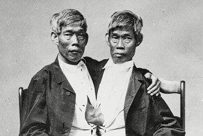 История братьев Банкер, благодаря которым появился термин "сиамские близнецы"