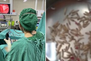 Жительница Таиланда обнаружила в носу сотни личинок