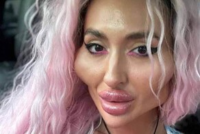 Украинка с «самыми большими в мире щеками» показала, как выглядела раньше