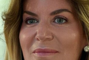 Жена президента Федерации еврейских общин ослепла на оба глаза из-за пластической операции