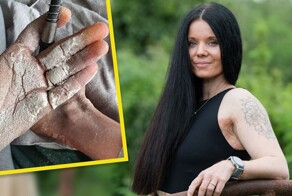 Женщине с болезнью "рыбьей чешуи" нужно наносить на себя 10 кг крема