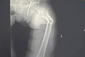 35-летний китаец сломал бедренную кость в результате кашля