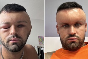 Как Мегамозг: лицо мужчины страшно раздуло