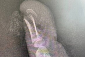 Хирурги спасли раздробленный ножкой стула палец 7-летней девочки