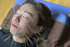 Модная акупунктурная техника превращает людей в дикобразов