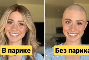 В парике и без парика: женщины с алопецией, которые смогли побороть комплексы