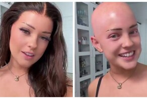 Тяжелая форма алопеции