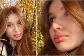 "У меня нет зависимости": девушка с 16 лет увеличивает губы