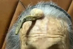 Секрет долголетия: женщина из Китая 107 лет живет с "дьявольским рогом" на лбу