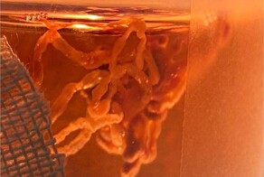 Московские хирурги спасли молодую женщину от инсульта, удалив гигантский 25-сантиметровый тромб