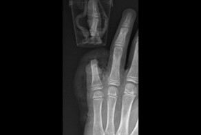 Микрохирурги помогли 12-летнему мальчику, отрубившему себе палец топором