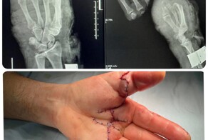 Травма на производстве. Врачи пришили сразу 5 пальцев во время одной операции⁠⁠