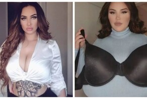 Женщина рассказала о борьбе с грудью 18 размера, которая не прекращает расти из-за редкого заболевания