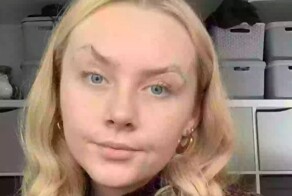 Женщине приходится клейкой лентой поднимать веки из-за редкого заболевания