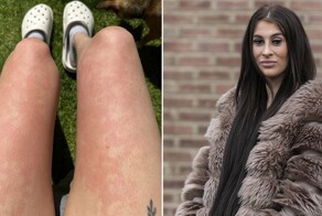 Британка страдает от аллергии, которая наблюдается у одного из 230 миллионов