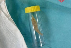 Врачи достали кусок курятины из бронхов 2-летнего мальчика