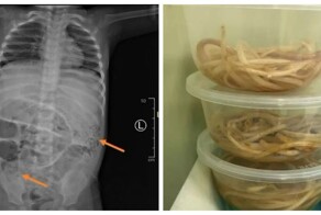 Напоминание не пить сырую воду: кадры извлечения из тела пациента гигантских червей