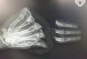 Врачи помогли мужчине, который отрезал себе 4 пальца циркулярной пилой⁠⁠