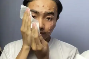 Парень заразился кожным заболеванием, просто примерив одежду в магазине