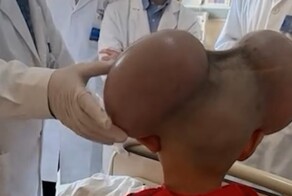 Мальчик, которого прозвали Микки Маусом, преобразился