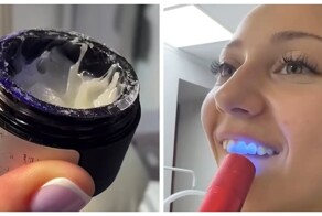 Наращивание зубов гель-лаком