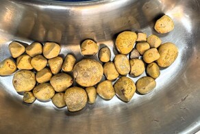 Любителю колы удалили 35 камней из мочевого пузыря