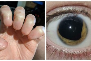 «Волос растёт в глазу»: 30 удивительных явлений, которые могут произойти с телом