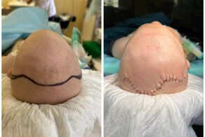 Врачи выровняли череп 8-месячному малышу с треугольной головой