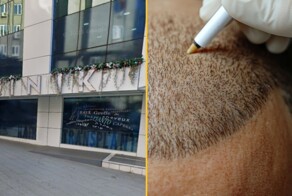 Британец умер во время пересадки волос в Турции