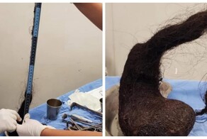 Потеряла в весе и страдала от депрессии: медики обнаружили в желудке трехлетней девочки огромный волосяной комок