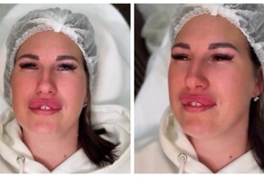 Как выглядит эффект «заячьих губок»