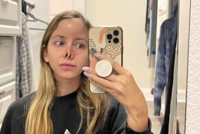 Женщине потребовалось 16 операций, чтобы восстановить нос после укуса собаки