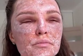 Красота с риском: как лазерная шлифовка лица калечит кожу