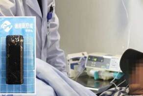 Врачи извлекли зажигалку из желудка мужчины, который в пьяном угаре проглотил её 30 лет назад