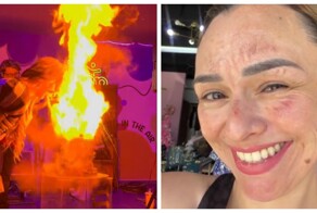 Девушка получила сильные ожоги лица на дне рождения