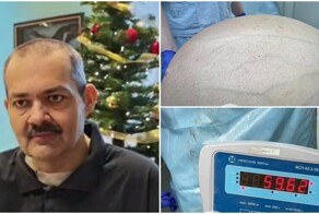 Мужчине удалили опухоль весом более 60 килограммов