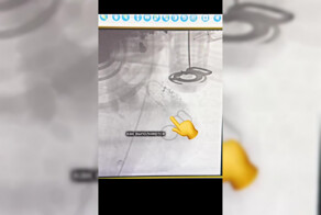 Сердце остановилось на 50 минут: хирурги восстановили кровоток и спасли пациентку