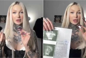 Лечение акне привело к костному наросту на ноге у девушки