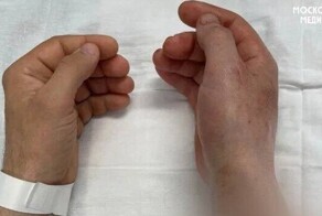 В России впервые провели успешную операцию по пересадке рук