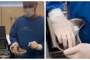 Медики извлекли десятки камней из мочевого пузыря любителя сладкой газировки