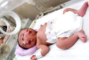 Родился ребенок с двумя лицами (5 фото)