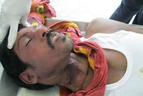 Шея самоубийцы - висельника (2 фото)