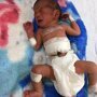 Индийский младенец родился со второй головой на животе
