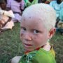 Альбиносы в Африке (8 фото)