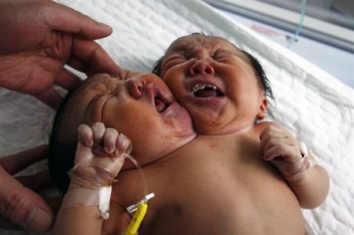 В Индии родился мальчик с двумя головами (видео)
