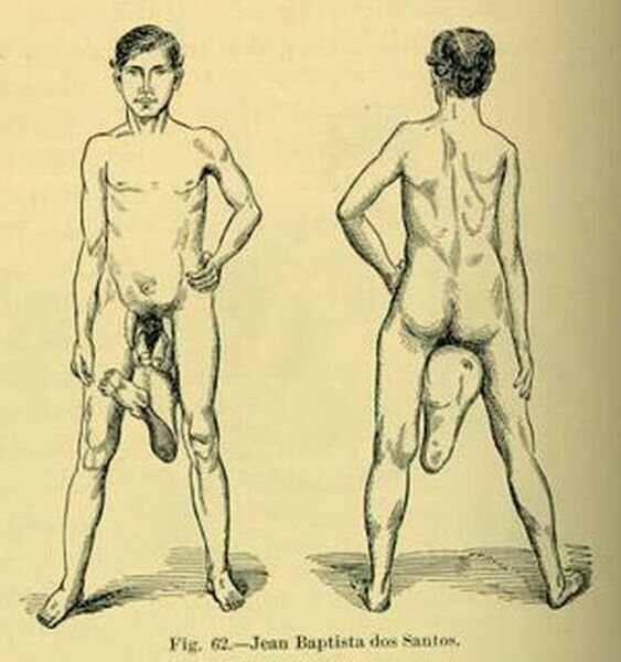 Человек с двумя пенисами (2 фото)