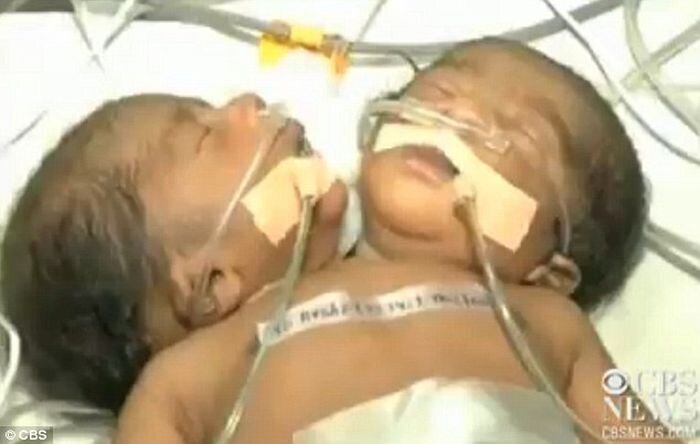 В Индии родился двухголовый ребенок (2 фото)