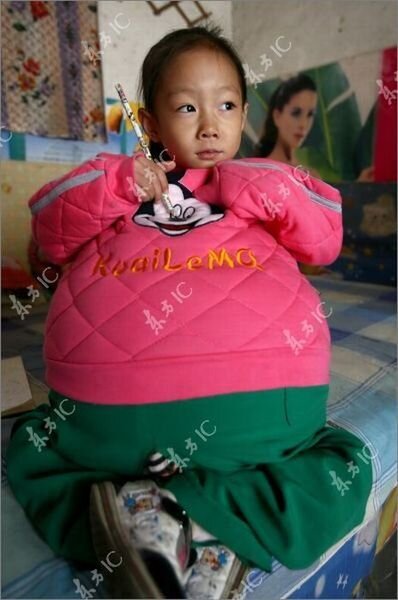 Маленькая девочка с огромным животом (19 фото)