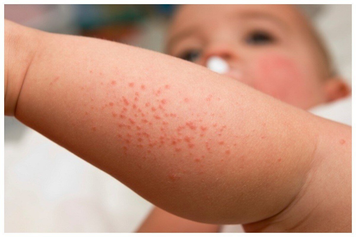 Alergia aguacate bebe